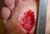 Diabetic Ulcer, Non Healing Wounds, Hyperbaric Oxygen Treatment