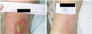 hyperbaric oxygen therapy - tissue oxygenation - foot ulcers - vasculitis study