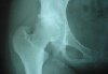 Refractory Osteomyelitis / Hyperbaric Oxygen Therapy / Hyperbaric Oxygen Treatment
