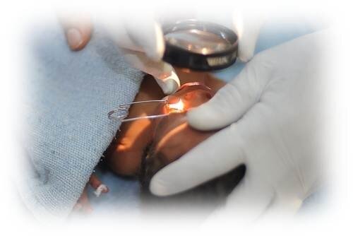 Retinopathy of prematurity / Hyperbaric Oxygen Therapy / Hyperbaric Oxygen Treatment