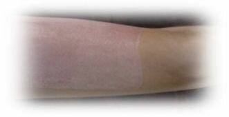 Skin Graft Donor Site - Hyperbaric Oxygen Therapy, Skin Burns