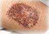 Compromized Skin Graft & Flaps / Hyperbaric Oxygen Therapy