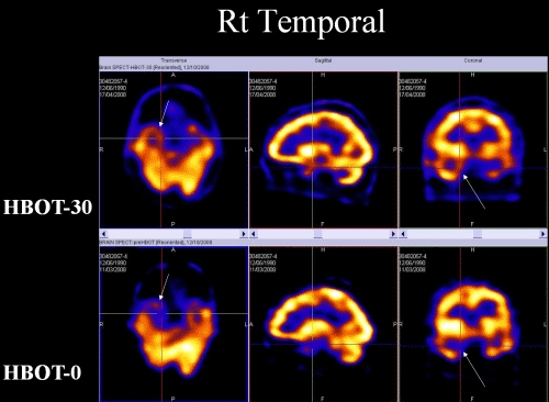 SPECT scan of brain after TBI before and after Hyperbaric Oxygen Therapy