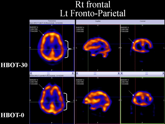 SPECT scan of brain after TBI before and after Hyperbaric Oxygen Therapy