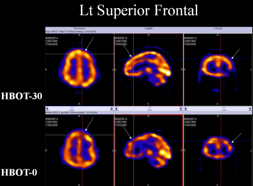 SPECT scan of brain after TBI before and after Hyperbaric Oxygen Therapy