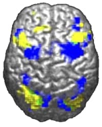 Brain hypoxia visualization
