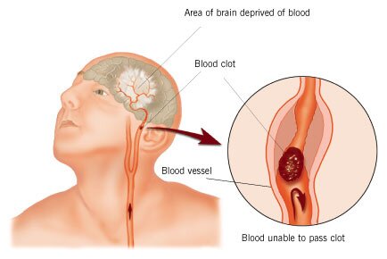 Cerebral Hypoxia, Brain Hypoxia, What is Hypoxia