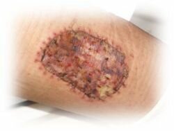 Skin Grafts - Hyperbaric Oxygen Therapy, Skin Burns